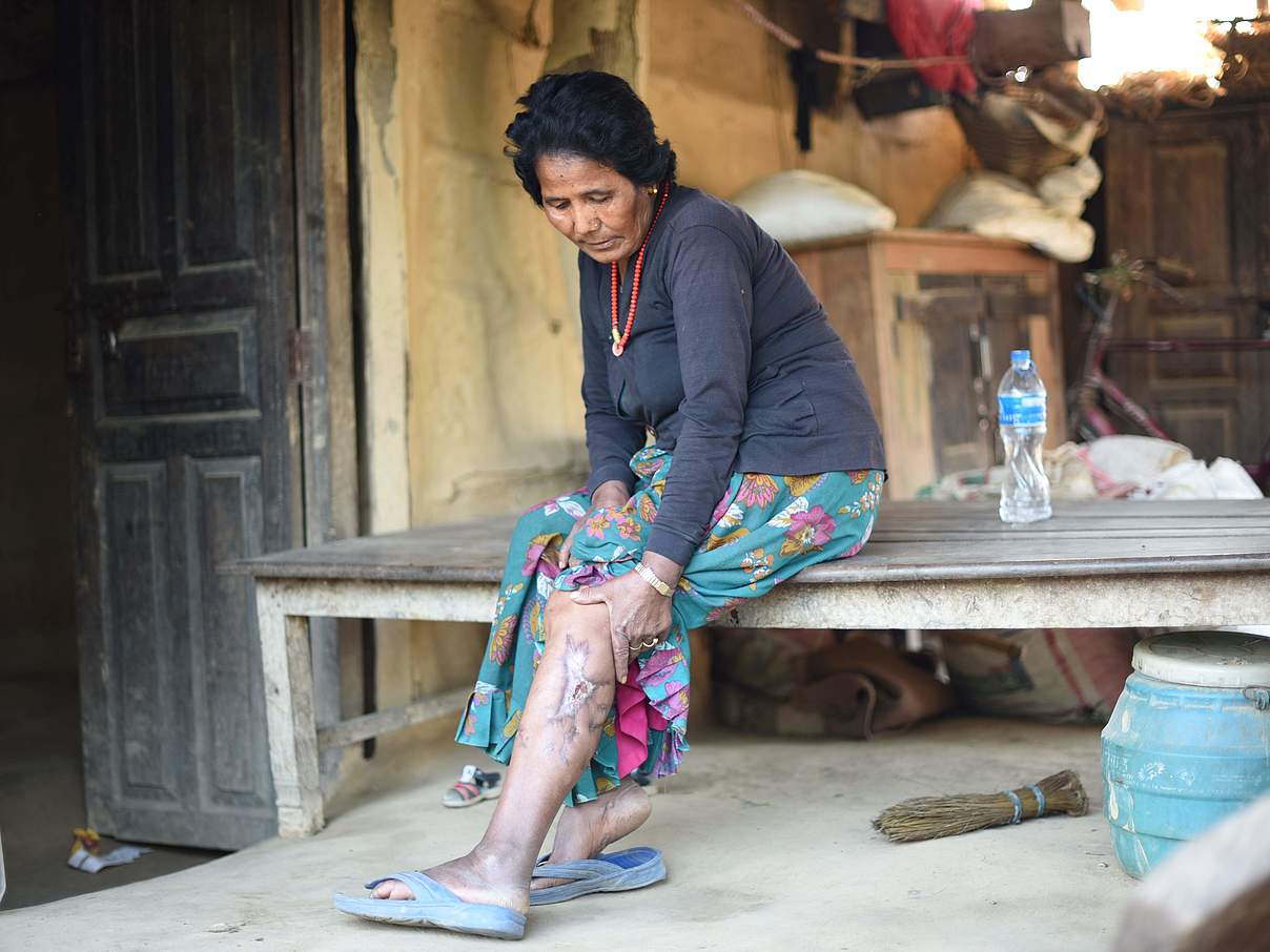 Frau mit Wunde von Leopard-Angriff © WWF Nepal